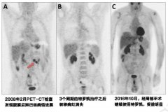 他竟然吃特罗凯9年不耐药，仅仅是因为运气好吗